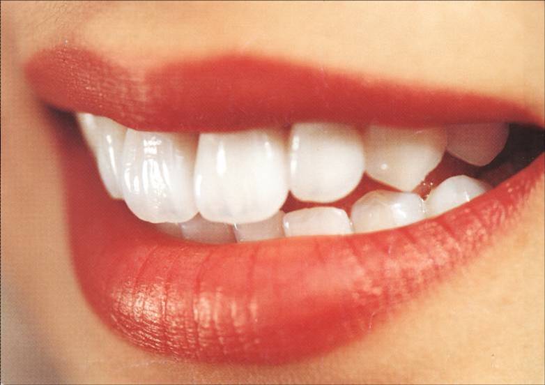 Foto 1 - Implantes dentarios